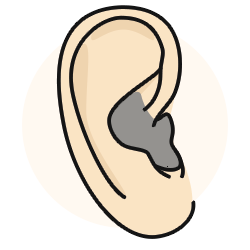 In the ear canal hearing aids work well for moderate sensorineural hearing loss.
