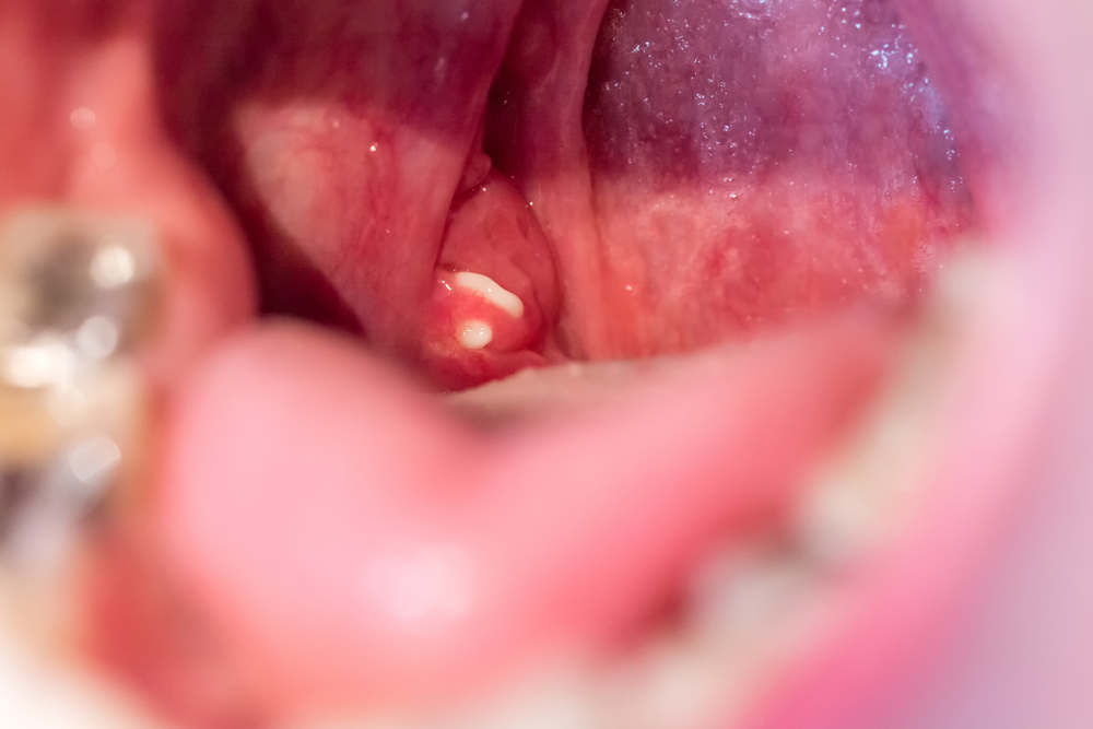 White almond stones on the palatine tonsils.